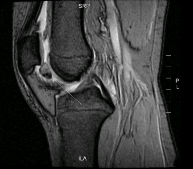 MRI showing localized PVNS on right knee